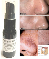 Salicylic Acid Serum 2% By ModelSupplies Eradicate Blackheads Clogged Pores Acne